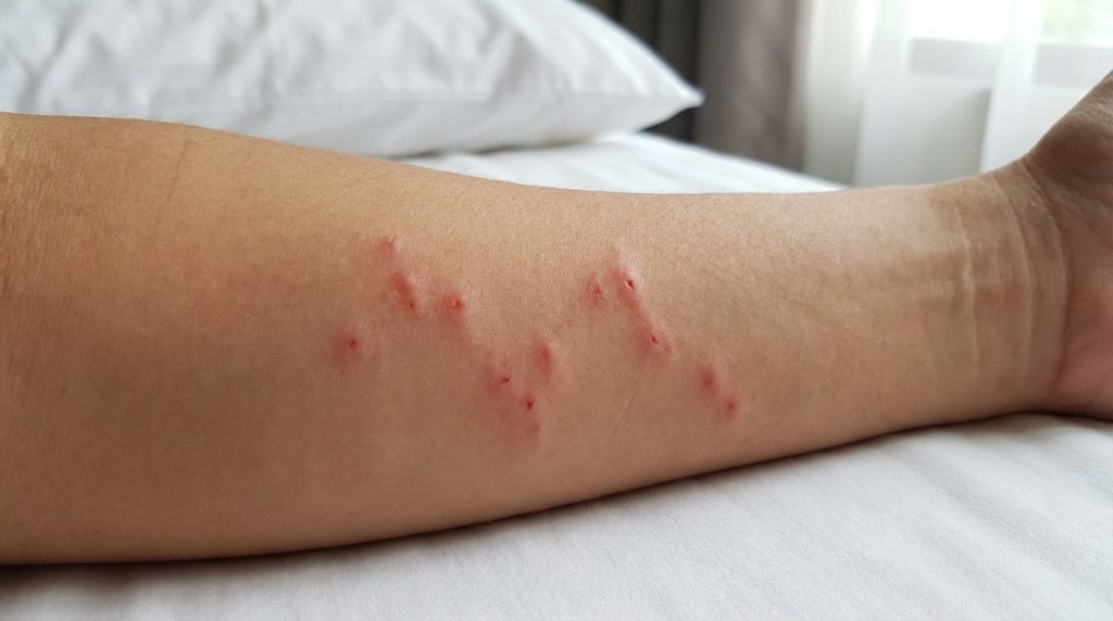 Comment reconnaître une piqure de punaise de lit ?