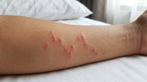 Lire la suite à propos de l’article Comment reconnaître une piqure de punaise de lit ?